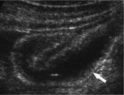 Right Lower Quadrant Pain: Ruling Out Appendicitis | Radiology Key