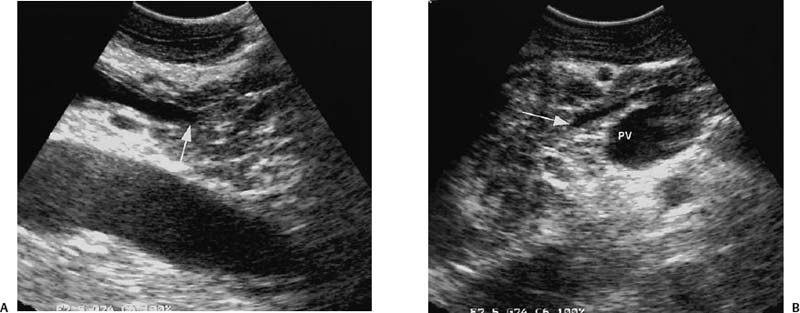 Intraoperative Ultrasound | Radiology Key