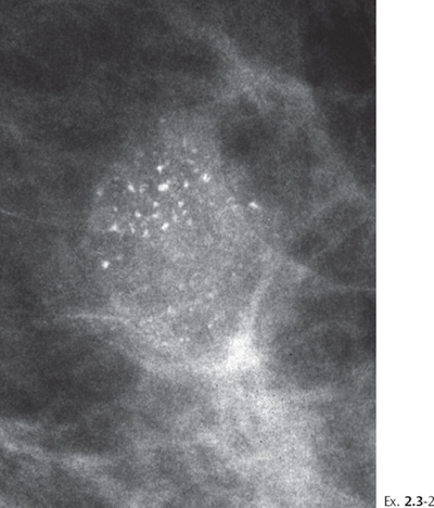 breast calcification clusters