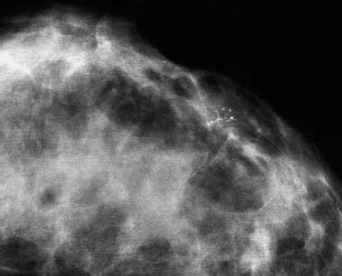 mammogram calcifications 93b fig
