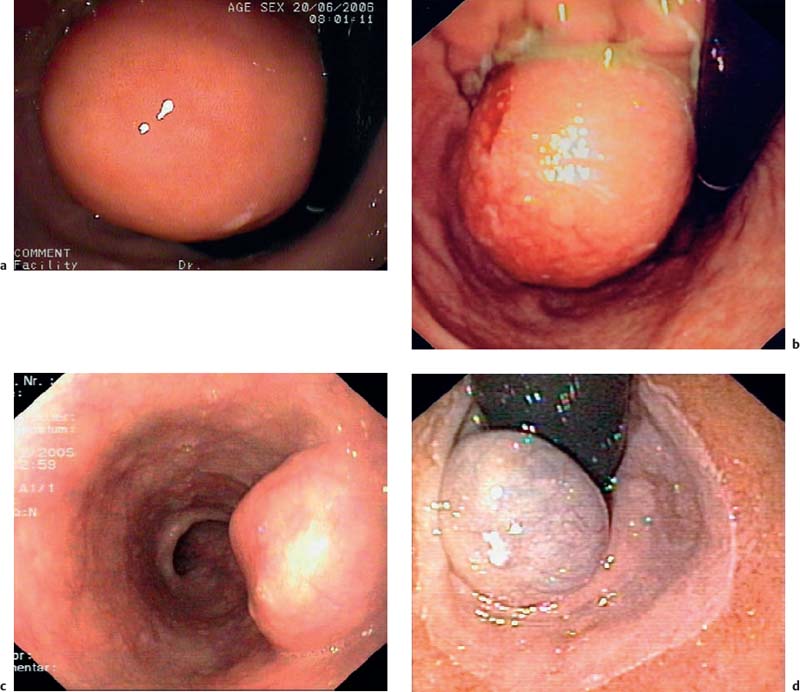 Endoscopic mucosal resection of the duodenal subepithelial 