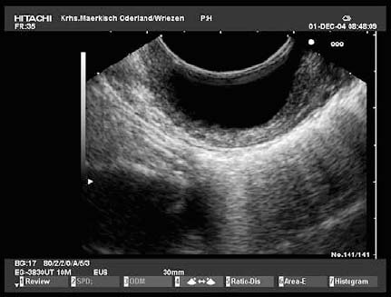 Endoscopic Ultrasound in Subepithelial Tumors of the Gastrointestinal ...