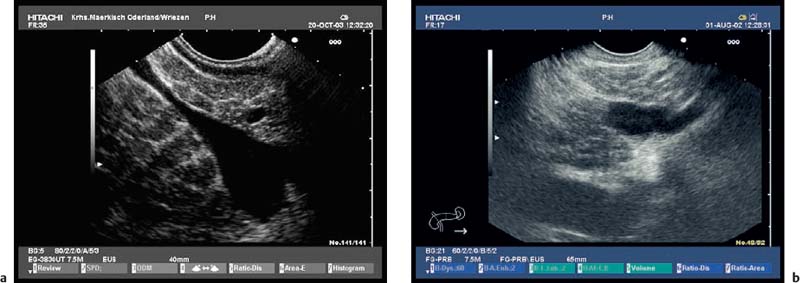 Endoscopic Ultrasound In Chronic Pancreatitis Radiology Key