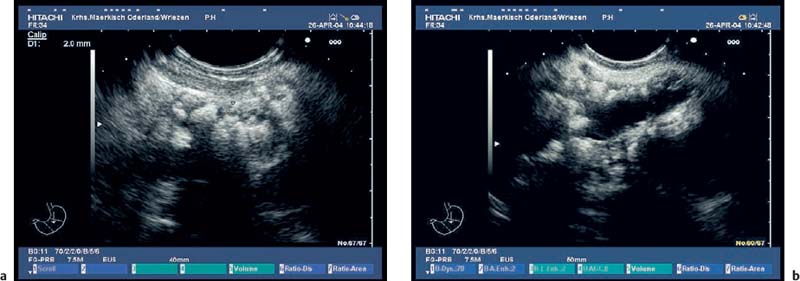 Endoscopic Ultrasound In Chronic Pancreatitis Radiology Key Hot Sex Picture