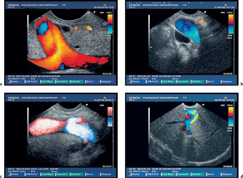 Endoscopic Ultrasound In Chronic Pancreatitis Radiology Key