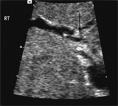 Ultrasound Follow-Up of Liver Transplantation | Radiology Key