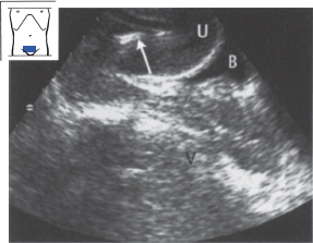 Bladder, Prostate, and Uterus | Radiology Key