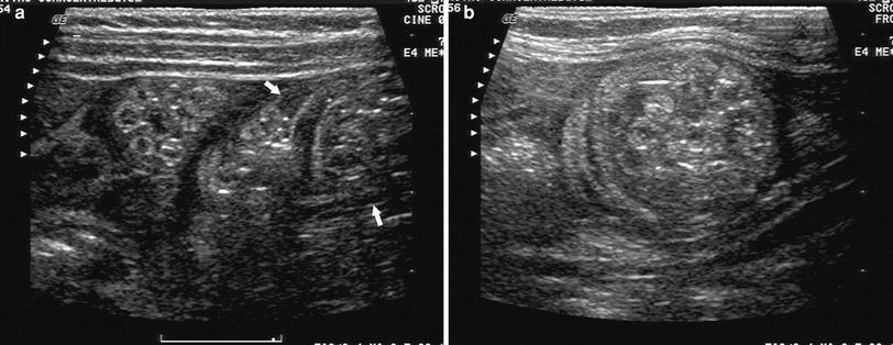 Ascariasis And Other Parasitic Enteritis Radiology Key 3476