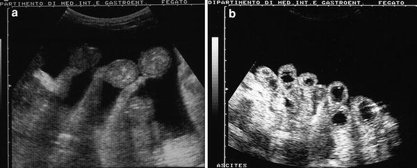 Omental cakes: unusual aetiologies and CT appearances | Insights into  Imaging | Full Text