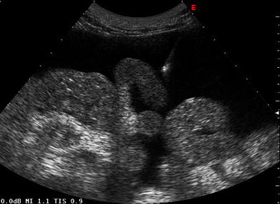 Omental cake | Radiology Case | Radiopaedia.org