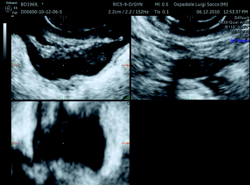 Intestinal Endometriosis | Radiology Key