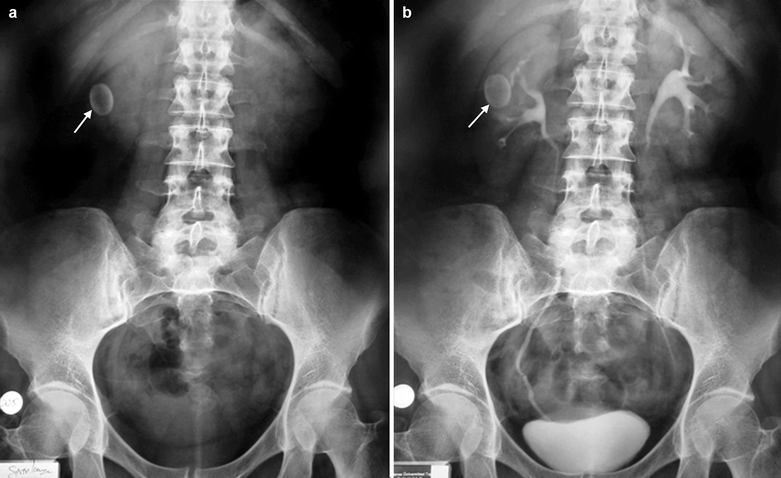 struvite stone x ray