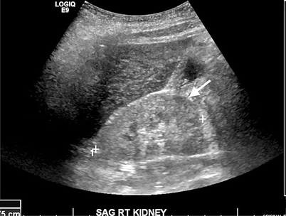 Medical Renal Disease and Transplantation Considerations | Radiology Key