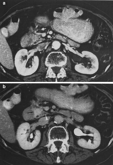 Late Effects of Radiation Treatment in the Pancreas | Radiology Key