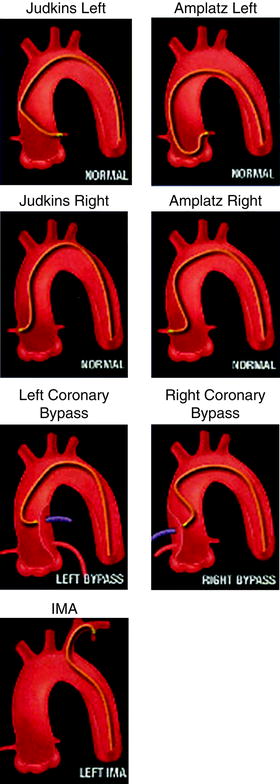 Coronary Angiography | Radiology Key