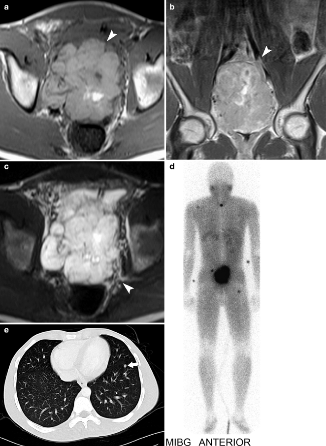 Pediatric Genitourinary Tumor Imaging Radiology Key