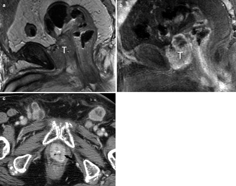 Bladder Cancer Imaging | Radiology Key