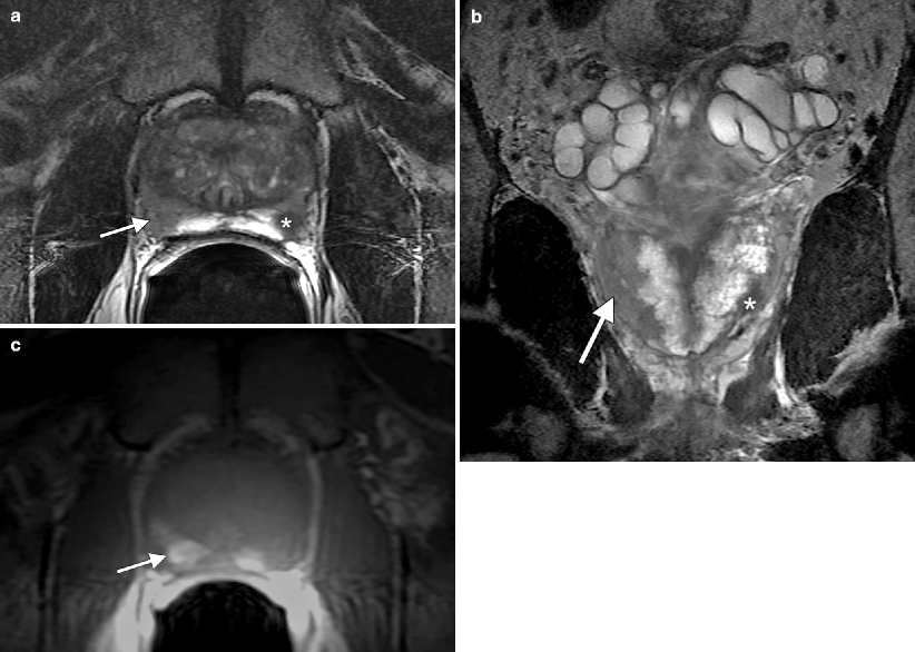 Prostate Cancer Imaging | Radiology Key