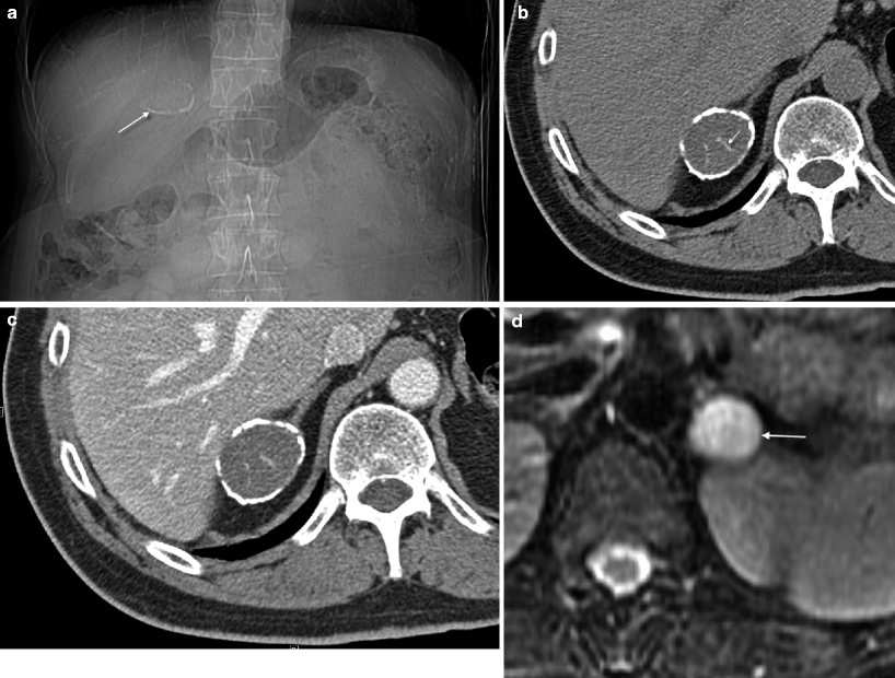 Imaging Of Adrenal Neoplasms | Radiology Key