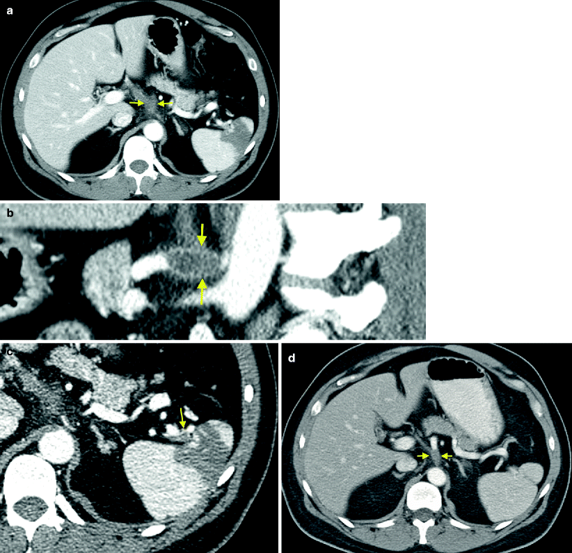 General Chemotherapy Imaging Radiology Key
