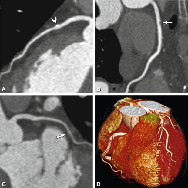 Transcatheter Aortic Valve Interventions | Radiology Key