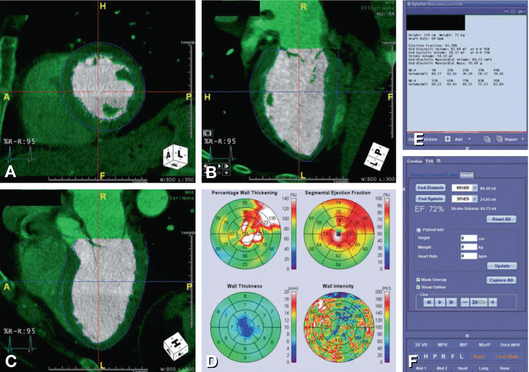 Cardiac Function | Radiology Key