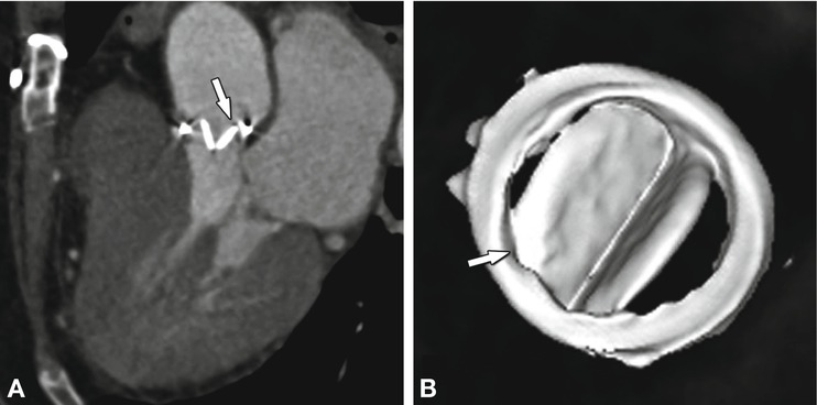 Cardiac Valves | Radiology Key