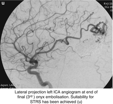 Treatment of Cerebral Arteriovenous Malformations | Radiology Key