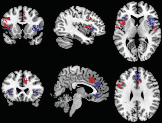 Neuroimaging In Schizophrenia | Radiology Key