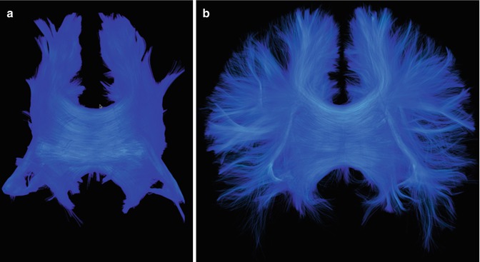 Diffusion Tensor Imaging | Radiology Key