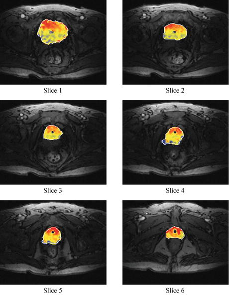 A Novel Image-Based Approach For Early Detection Of Prostate Cancer ...