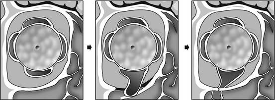 cme-30-03-17-penetrating-neck-trauma-charlie-s-ed