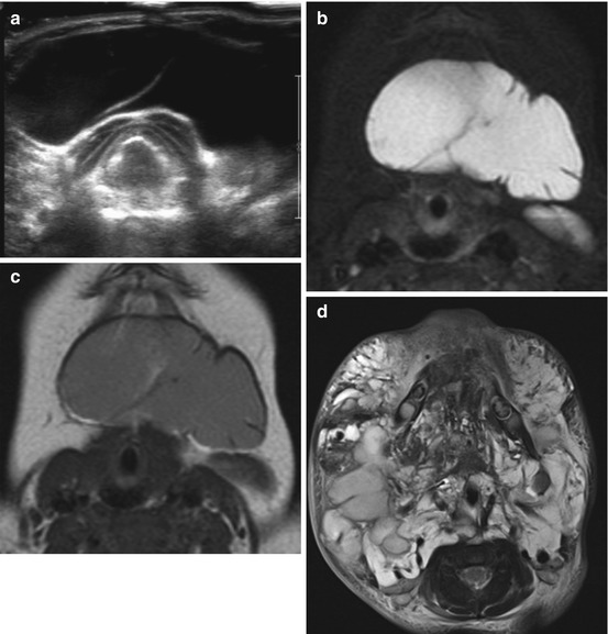 Pediatric Head and Neck Lesions | Radiology Key