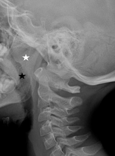 Nasopharynx | Radiology Key