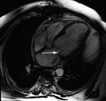 The Heart | Radiology Key