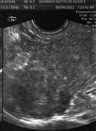 uterus fibroids ultrasound