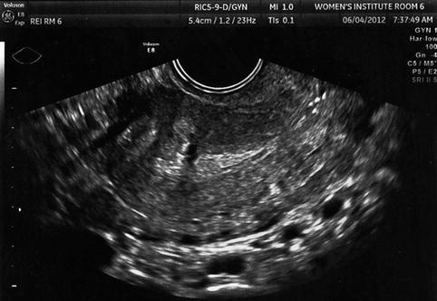 uterus fibroid ultrasound