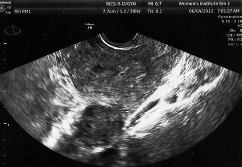 uterus fibroids ultrasound