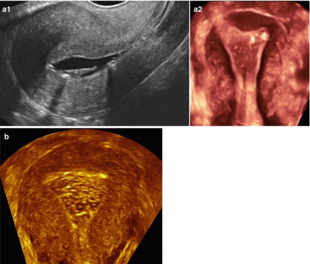 Congenital Uterine Anomalies 