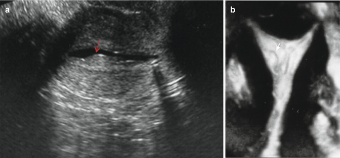 endometrial-polyps-radiology-key