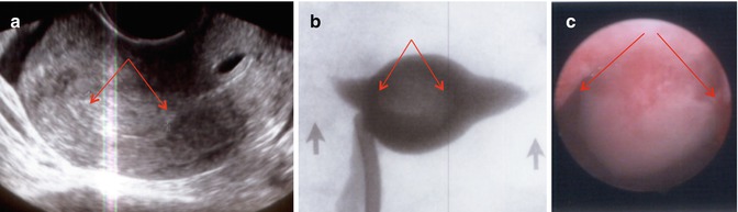 Endometrial Polyps Radiology Key