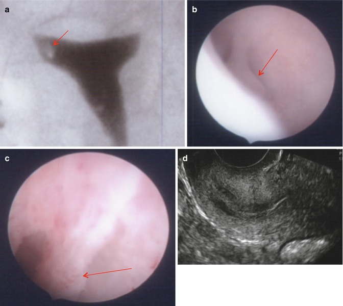 biopsy of polyp on uterus