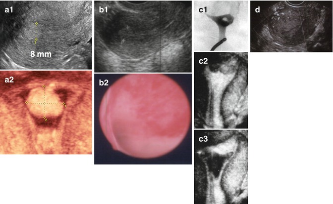 Endometrial Polyp Size Chart