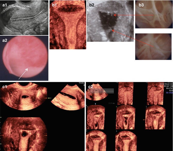 Endometrial Polyp Size Chart