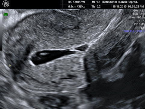 Sonohysterography In Reproductive Medicine Radiology Key