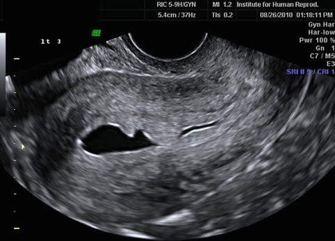 Sonohysterography in Reproductive Medicine | Radiology Key