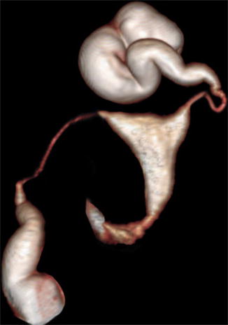 Virtual Hysterosalpingography: A New Diagnostic Technique for the Study ...