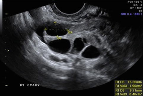 Number of small (5–10 mm) and medium (11–14 mm) size follicles in