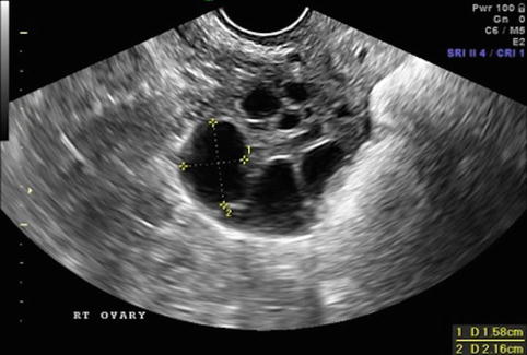 A–C) Sonograms of the dominant follicle (Ø 22, 32 and 38 mm) in a