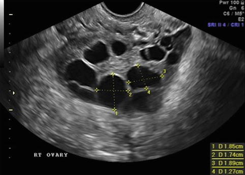 2D Ultrasound in Follicle Monitoring for ART